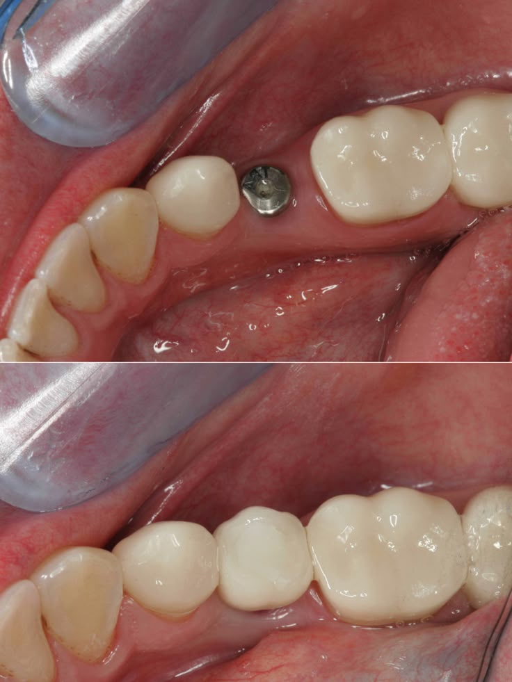 Dental implant final result